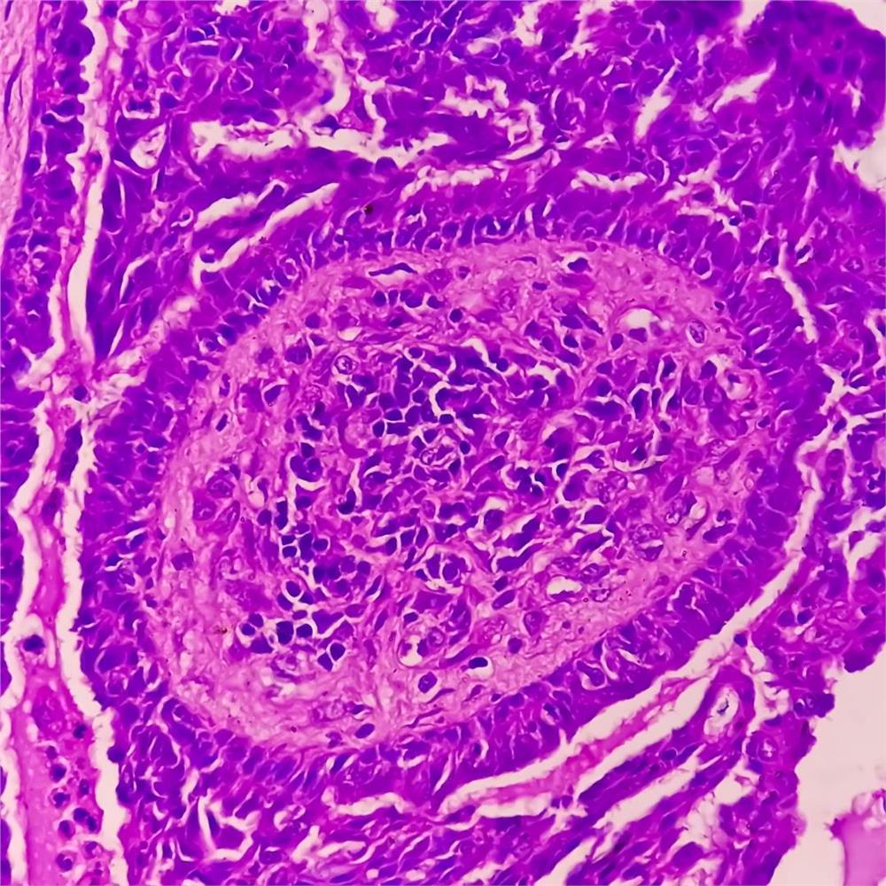 Endometrial polip gösteren rahim biyopsisinin fotomikrografı.