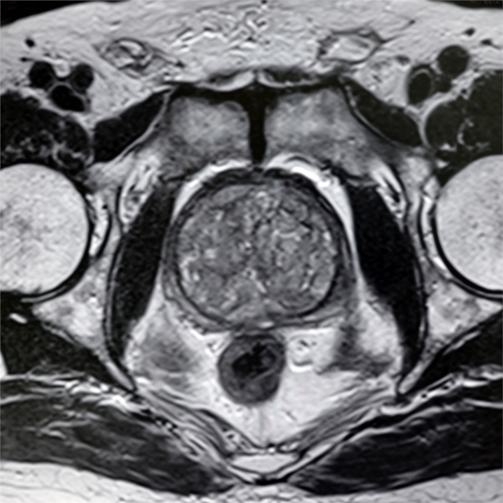 İyi huylu prostat hiperplazisi MRI T2 ağırlık görüntüsü