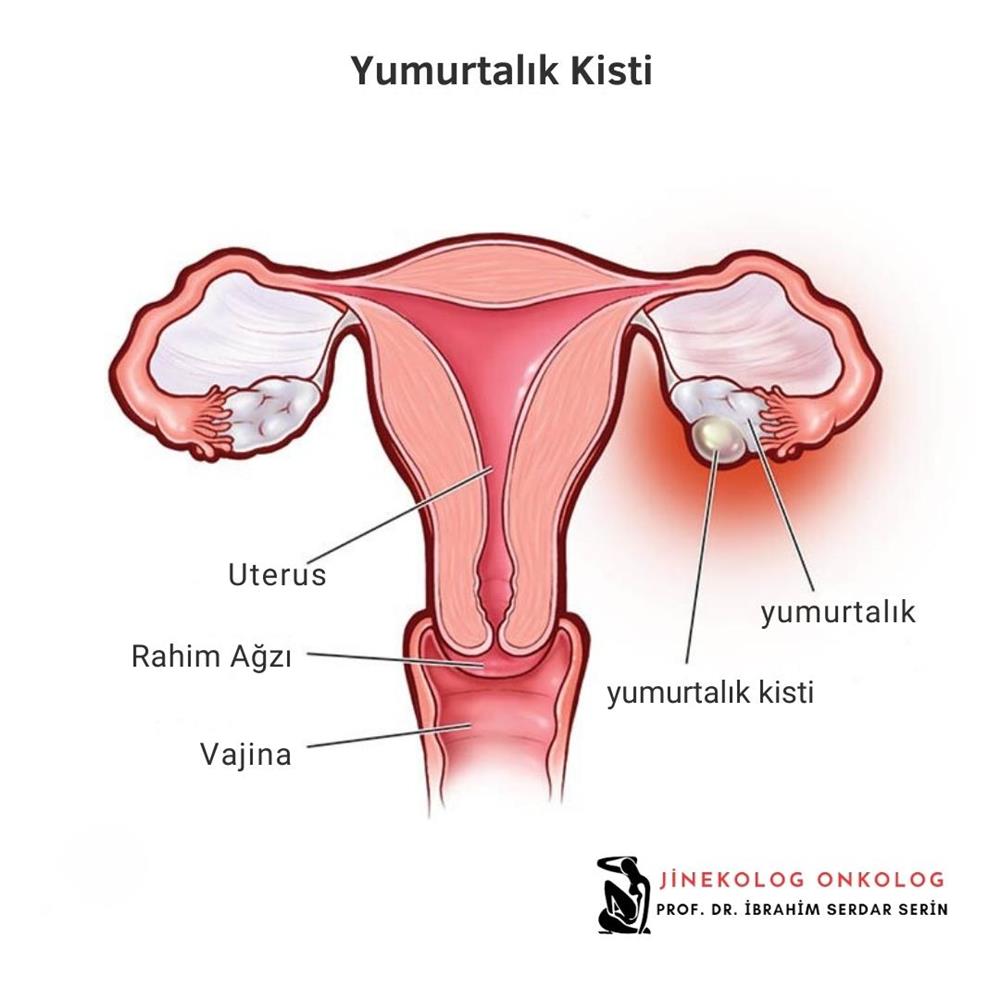 Yumurtalık üzerinde oluşan yumurtalık kisti.